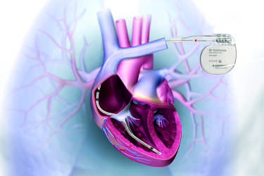 Pacemaker Device Implant, Treatment for Irregular Heart Beat, Cost of Pacemaker Device Surgery, APG Hospital, Purnia